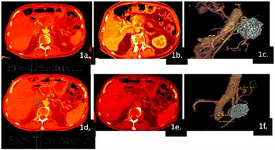 Utilization of a novel 3D radiologic scoring method to define therapeutic response and surgical candidacy